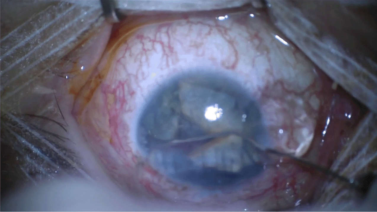 ac-iofb-scleral-tunnel.png